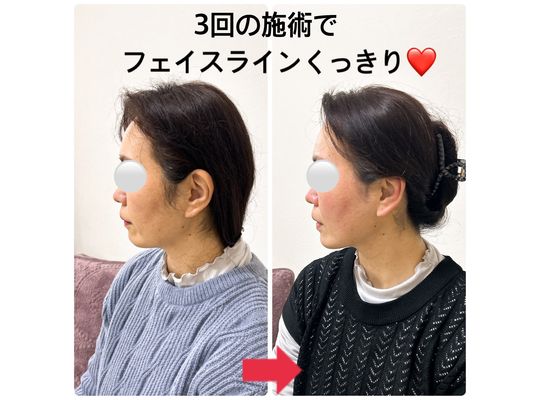 フェイスライン