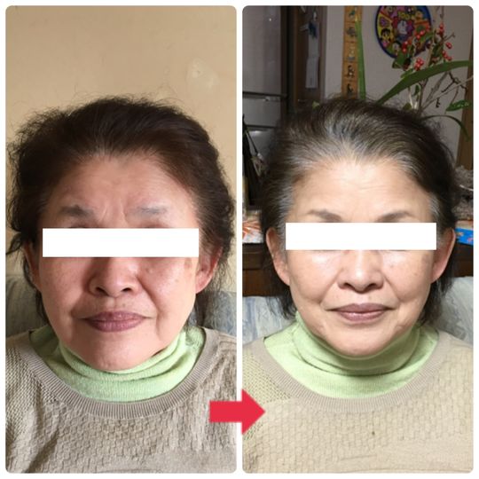 60代女性ビフォーアフター