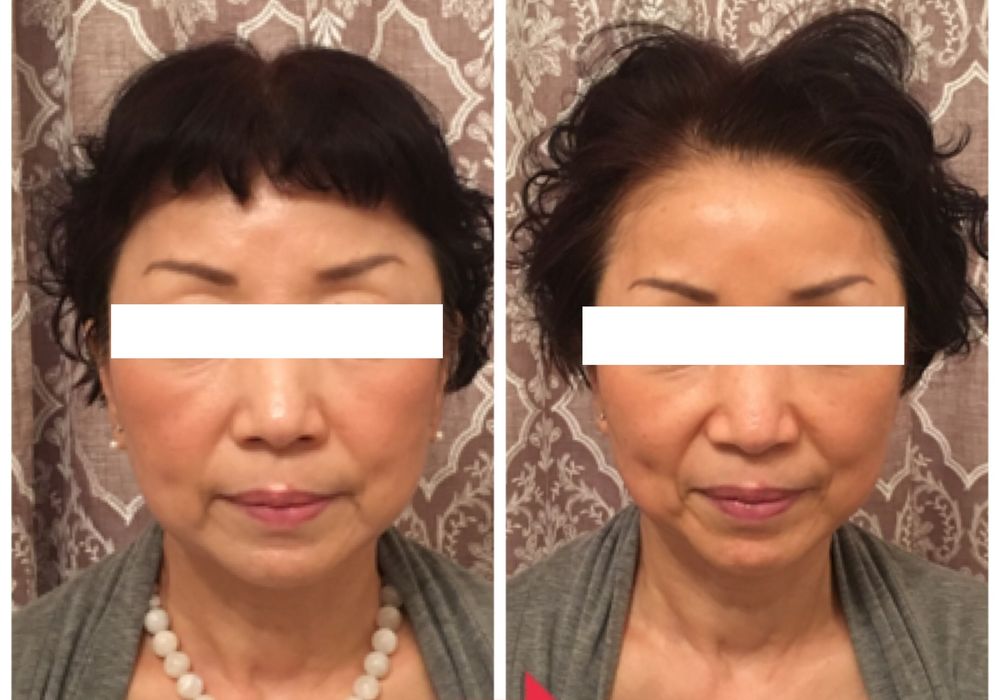 60代女性ビフォーアフター