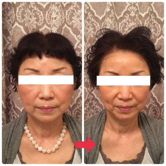 60代女性ビフォーアフター