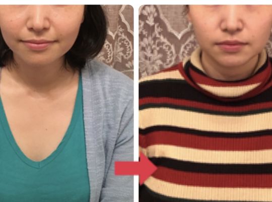 若返る小顔矯正