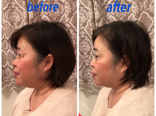 50代リフトアップ