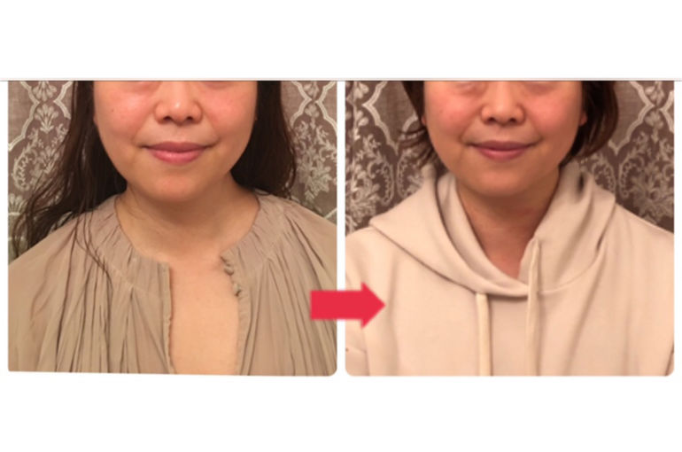 小顔矯正 福岡 たるみ改善で若返る