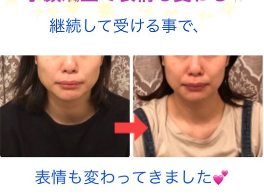 継続して小顔
