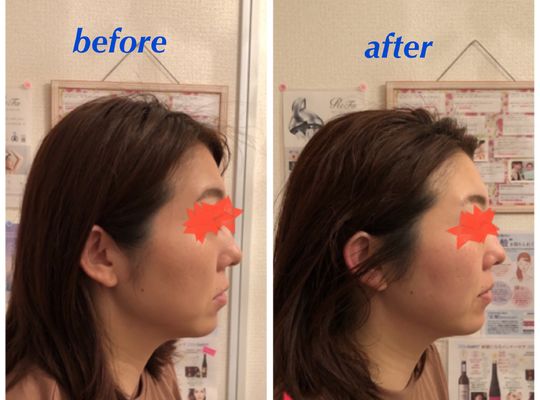 久しぶりの小顔矯正