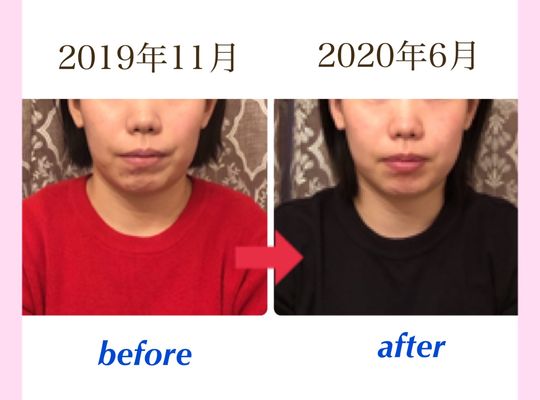 フェイスラインすっきり